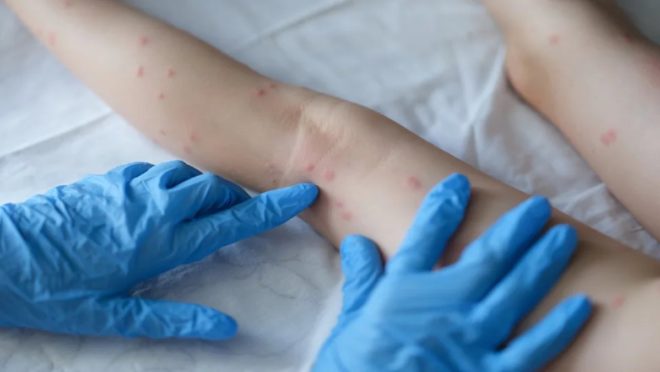 Anvisa recebe pedido da Saúde para liberação da vacina contra a varíola dos macacos