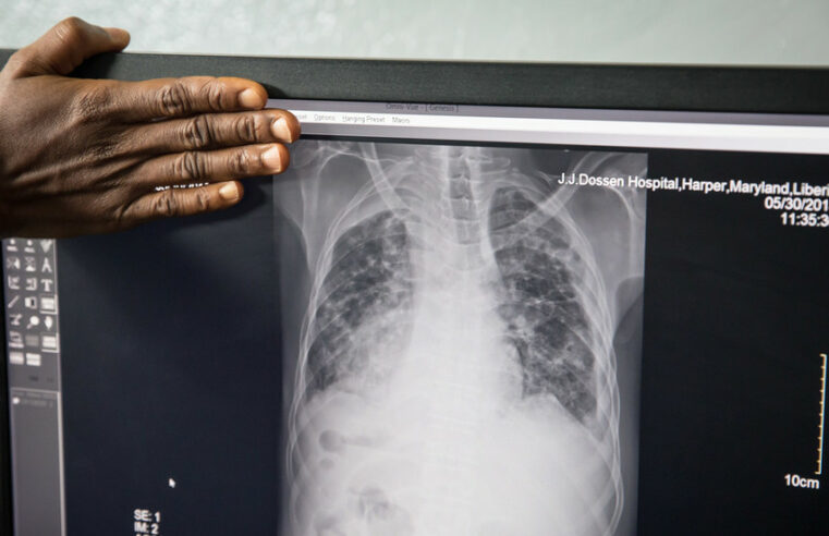 OMS emite alerta sobre tuberculose — RT World News