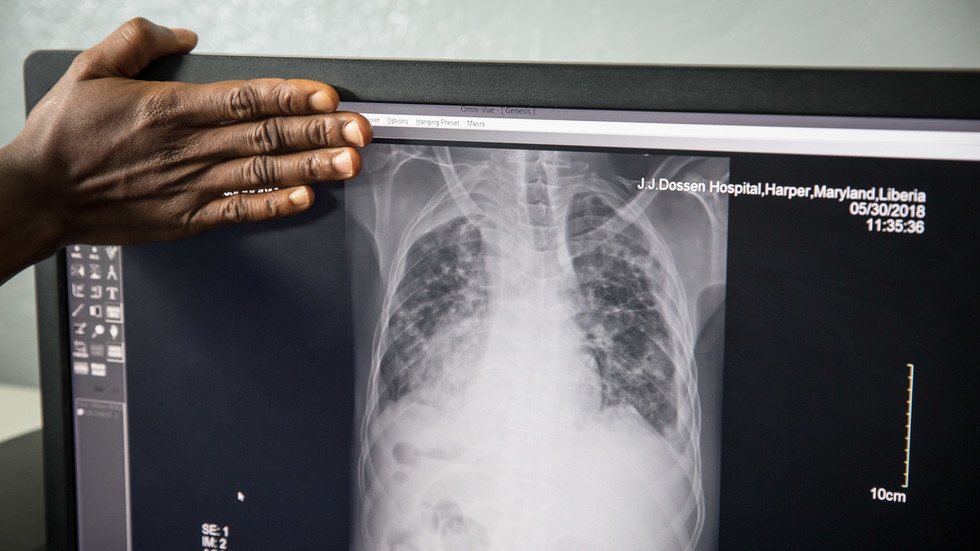 OMS emite alerta sobre tuberculose — RT World News